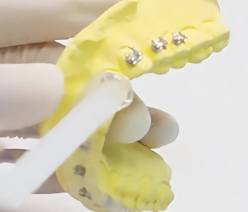 Orthodontic Procedure Step