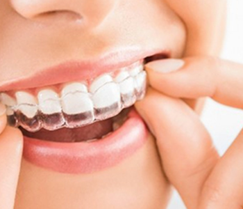 Invisible Aligner