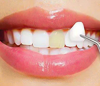 Veneers